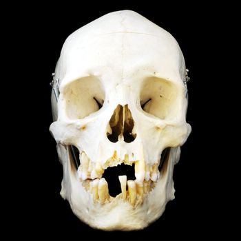 Real human skull with hinged jaw and some missing teeth.  Front view.