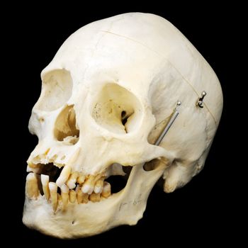 Human skull with jaw on a spring and some missing teeth.  Three quarter view.