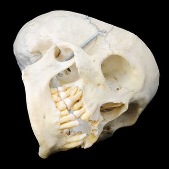 Real human skull with hinged jaw and some missing teeth.  Sideways view with skullcap removed.