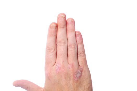 psoriasis on the hands and fingernails - Close-up