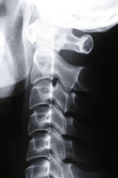 X-Ray Photo Of The Neck Area, Backbone And Part Of The Scull