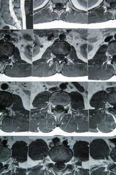 cross section of magnetic resonance imaging on spine
