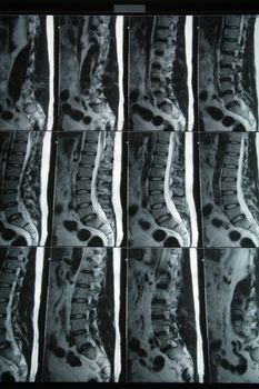 multiple chart of magnetic resonance imaging  on spine
