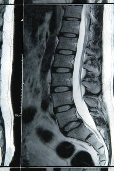 magnetic resonance imaging result of a spine
