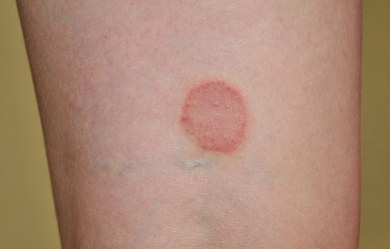 lichen ruber planus on the leg of young woman