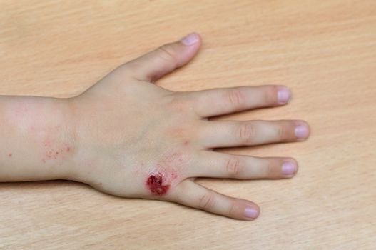  diathesis ( food allergy) on the hand of child