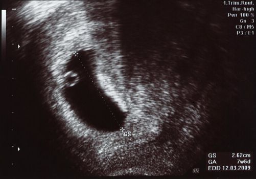 Ultrasound scan of a one month old new life baby.