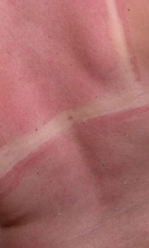 red sunburned female skin with white unsuntanned strips of skin shilded bikini