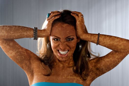 A woman posing with a medical skin condition that looks like vitiligo or leucoderma.