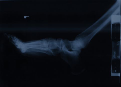 X-ray of a ankle joint 