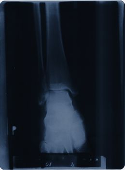 X-ray of a ankle joint 