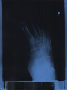 X-ray of a ankle joint 