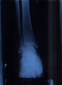 X-ray of a ankle joint 