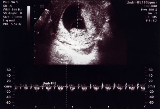Ultrasound scan 10 weeks of new human life and the heartbeat rate