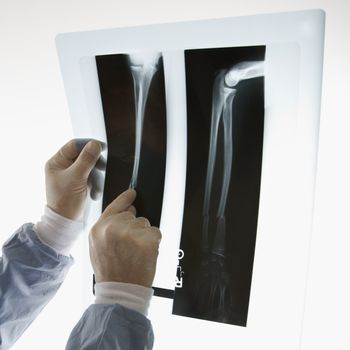 Mid-adult Caucasian male doctor pointing at an x-ray.