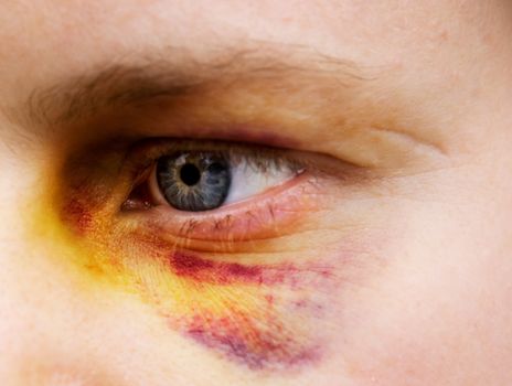 Black eye detail of a woman - purple yellow and black
