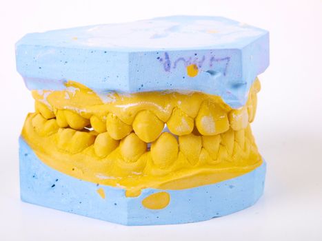 teeth plaster cast