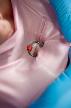 Tooth protected by a silicone rubber and a metal ring for dental treatment