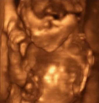 Three Dimensional Ultrasonography of Fourth Month Fetus
