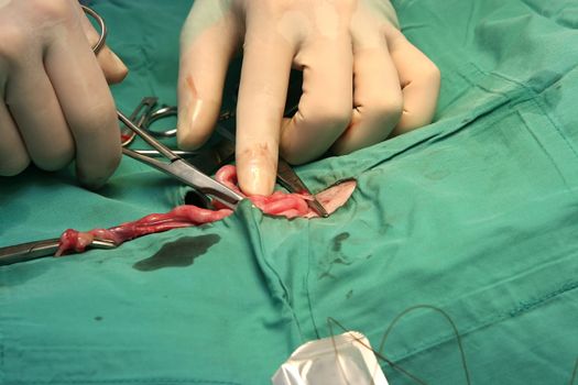 Surgeon doing an operation on an intestine
