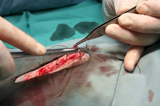 A surgeon is closing a wound by stitching