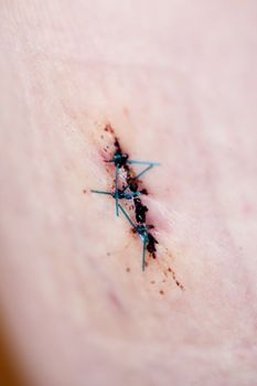 A background detail image of stitches on human skin - shallow depth of field