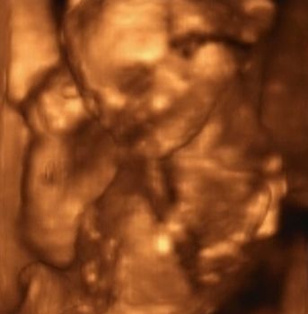 Three Dimensional Ultrasonography of Fourth Month Fetus