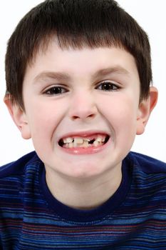 Young boy grimacing and showing off his missing milk tooth