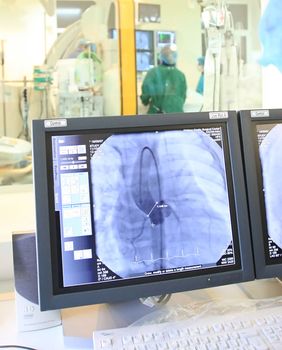 Doctor looking at a computer monitor during heart operation 