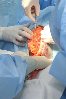 New baby being born during cesarean section
