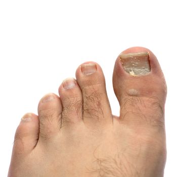 Closeup of a hairy human foot and toes with a cracked and peeling toe nail on the largest toe.  