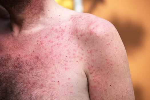 Rash or sun allergy - red pimples on the skin