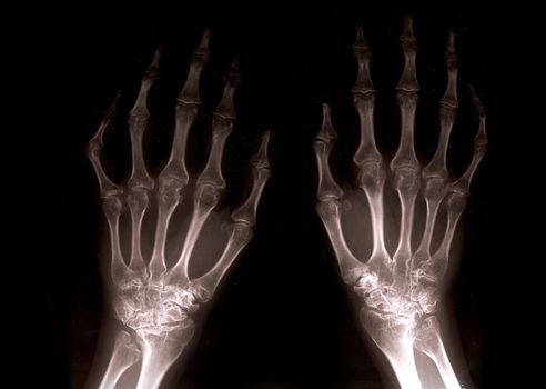 close up of xray hands with black background backlight