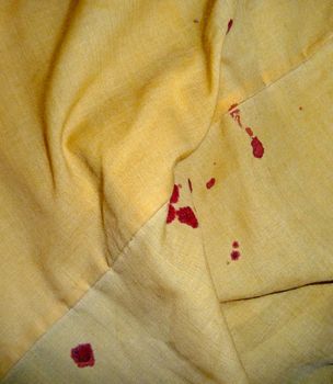 Blood on bedsheets caused by a nosebleed.