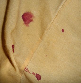 Blood on bedsheets caused by a nosebleed.