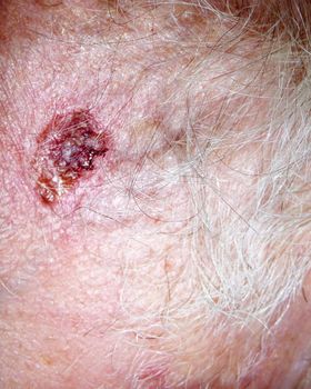 A scab on hairy human flesh.