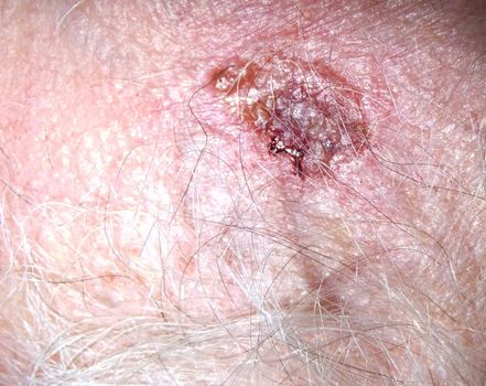 A scab on hairy human flesh.