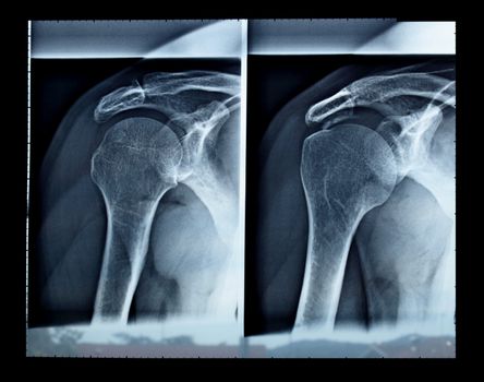 Medical X-Ray imaging of a shoulder, used in diagnostic radiology of skeleton bones