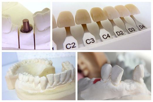 Dental technician collage with plaster mouth, implant abutment and dental shade guide