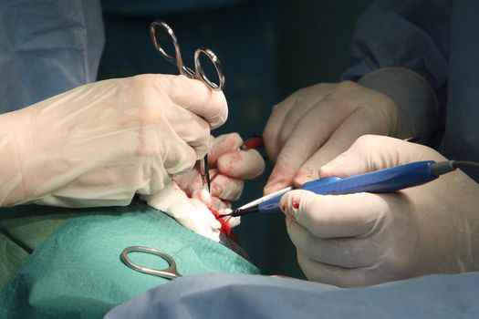 Surgical operation - implantation of bone implant in temporal bone