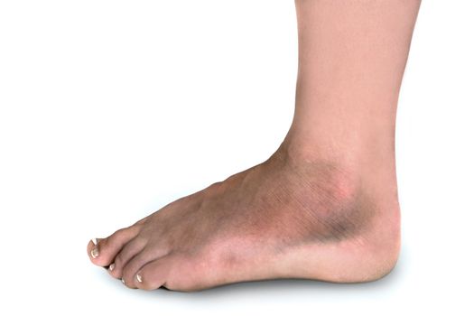 Woman With Swollen Broken Foot Covered With Bruises on White Background