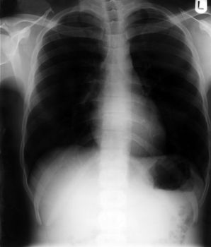 Chest x-ray during health screening