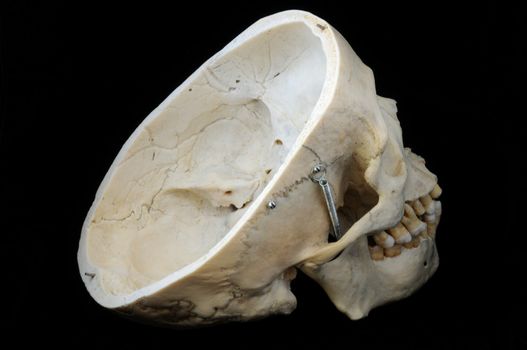 A real human skull with the cap cut away to show the interior of the brain case.