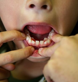 Minor showing off crooked teeth and spacers the orthodontist installed in preparation for braces