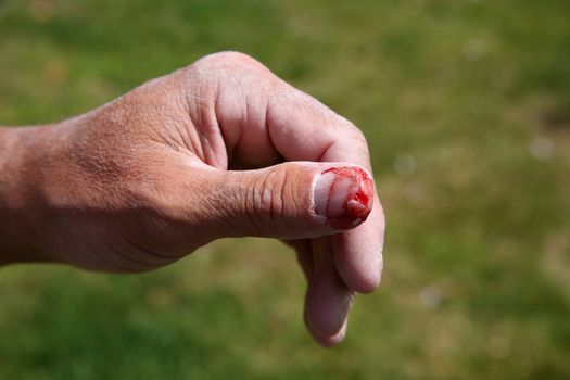 Construction worker with dusty hand and injured bloody thumb