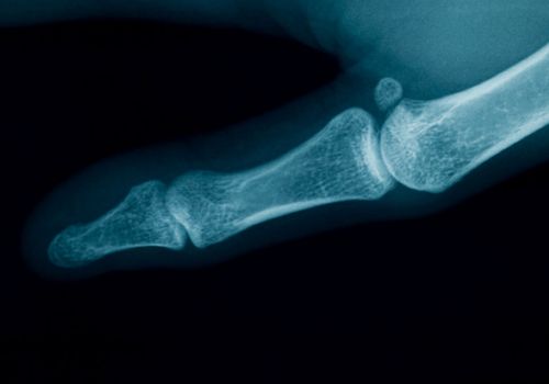 radiography of a middle aged woman finger