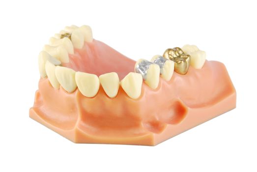 dental model showing different types of treatments on white (gold crown, porcelain veener, gold inlays, amalgam and composite fillings)