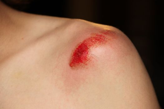 Bleeding Shoulder Injury of a Yong Child