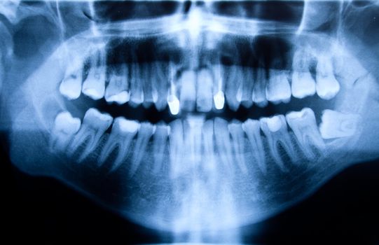 Full mouth panoramic in X-ray, showing all the teeth