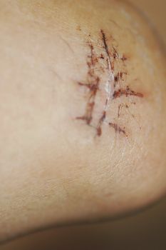Close up of scar with stitches on elbow